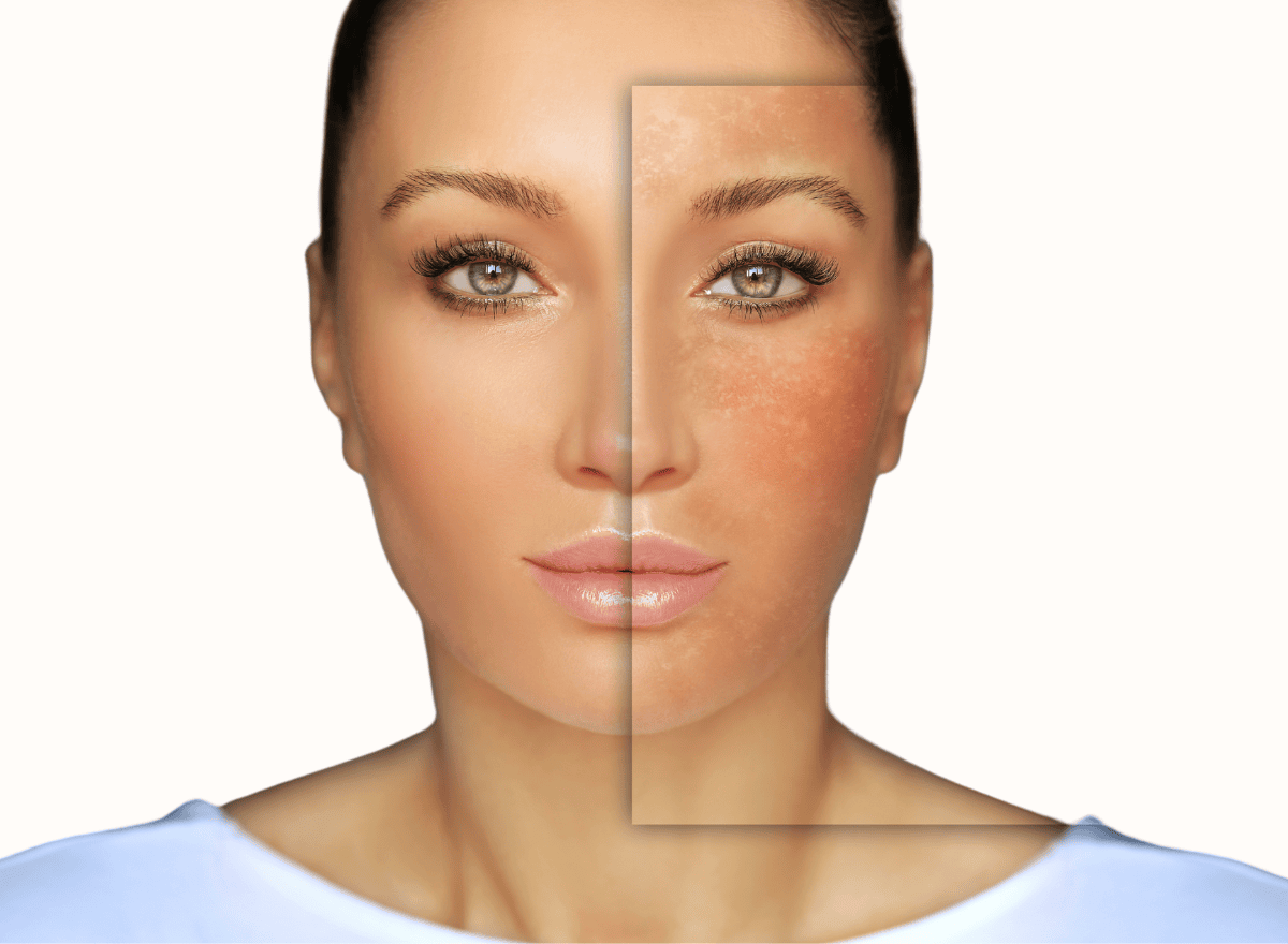 Hyperpigmentation